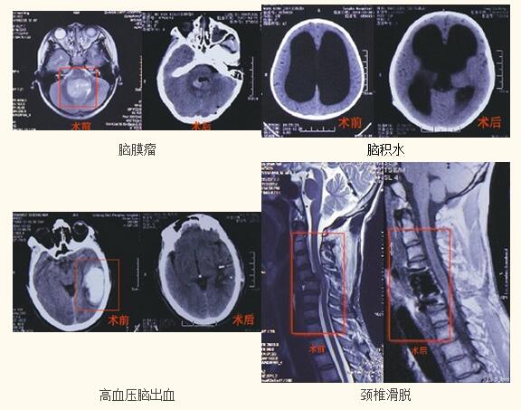 脑瘫手术的意义